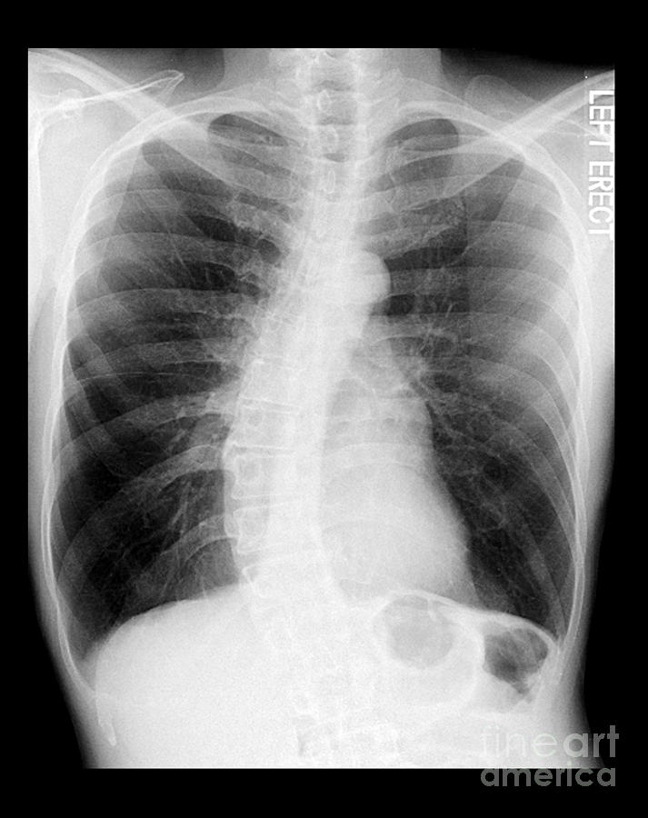 Chest Xray Photograph - Chest X-ray - Copd And Scoliosis by Medical Body Scans