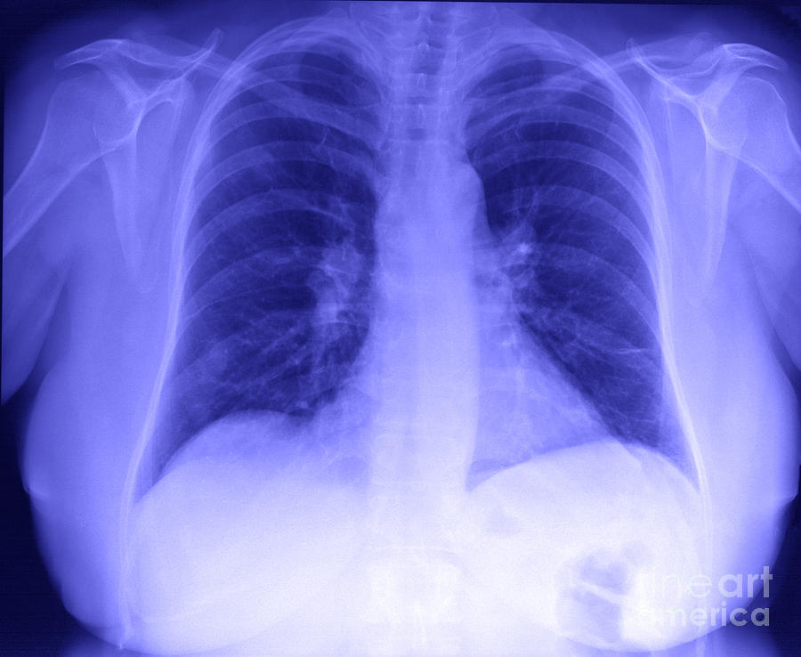 Chest X-ray Photograph by Ted Kinsman