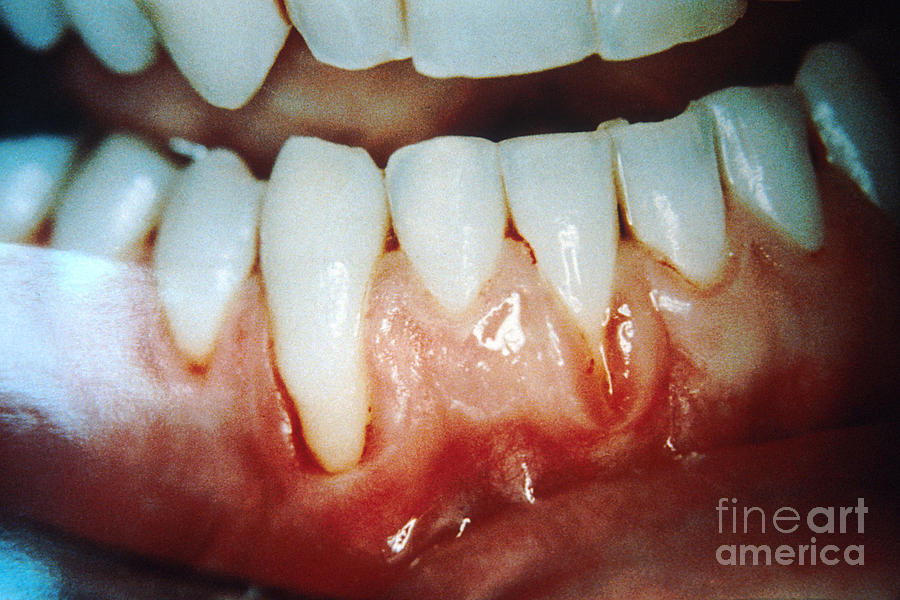 Chewing Tobacco Damage Photograph by Science Source