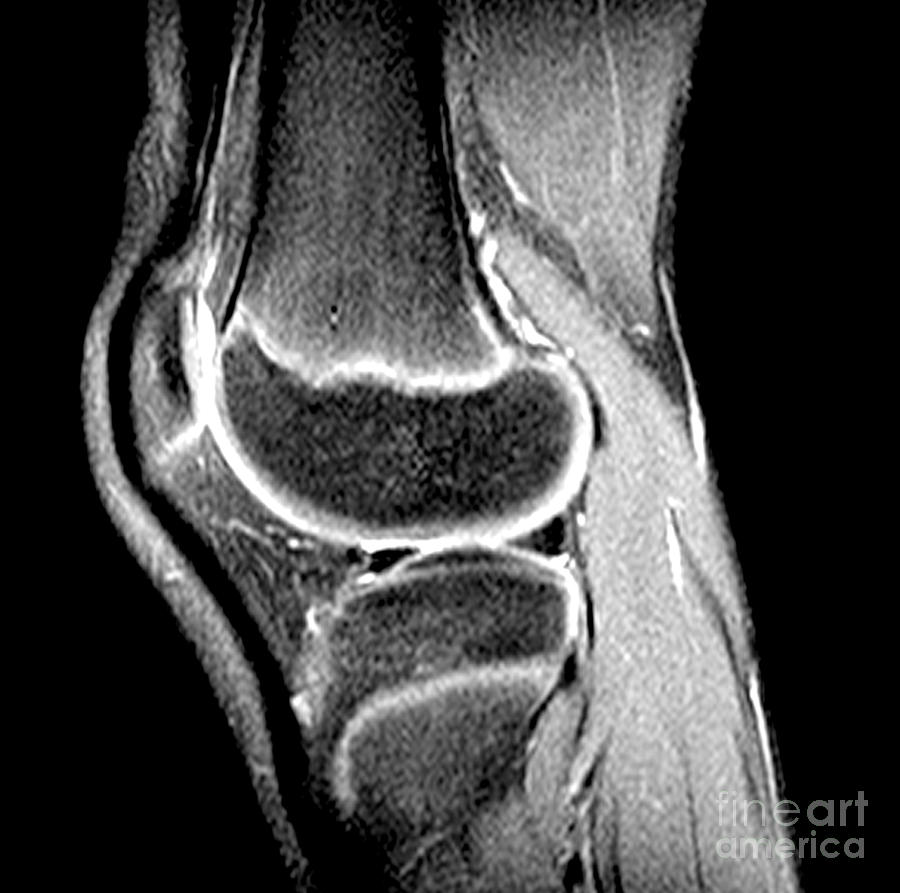 Childs Knee Photograph By Medical Body Scans - Fine Art America