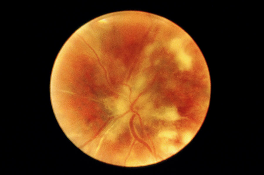 Chorioretinitis Photograph - Chorioretinitis Of The Eye by National Cancer Institute
