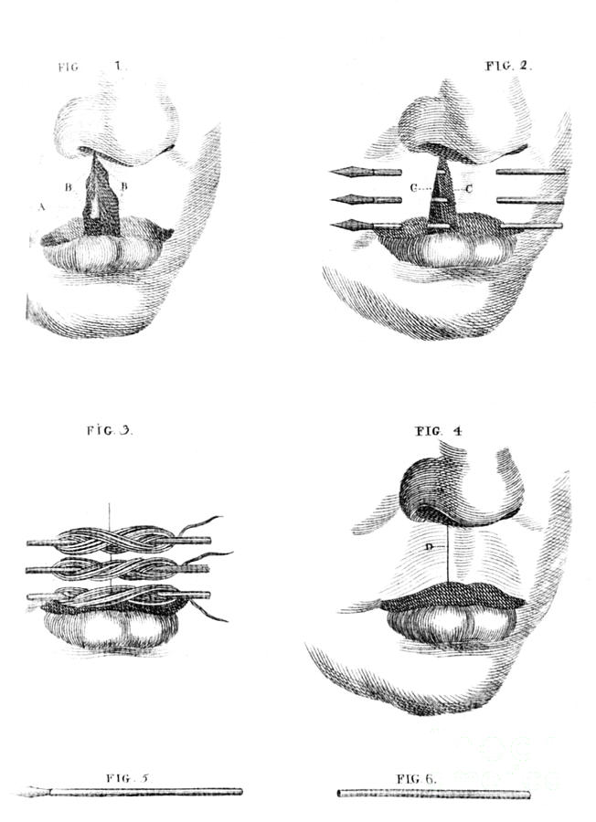 Cleft Lip Surgery, 1791 Photograph by Science Source