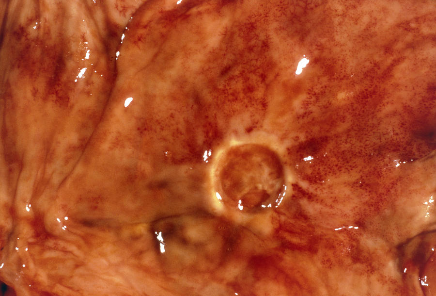 Ulcer Photograph - Clincal Photo Of Stomach Ulcer by Cnri