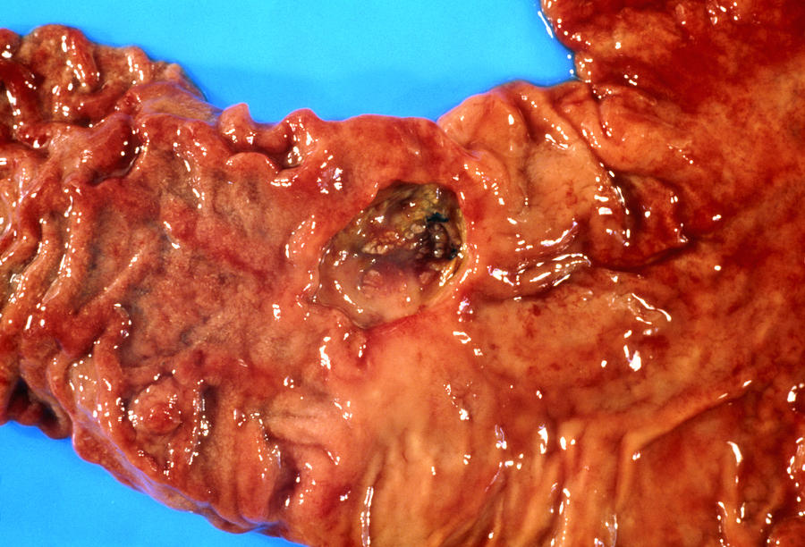 Duodenal Ulcer Photograph - Close-up Showing A Duodenal Ulcer by Dr. E. Walker