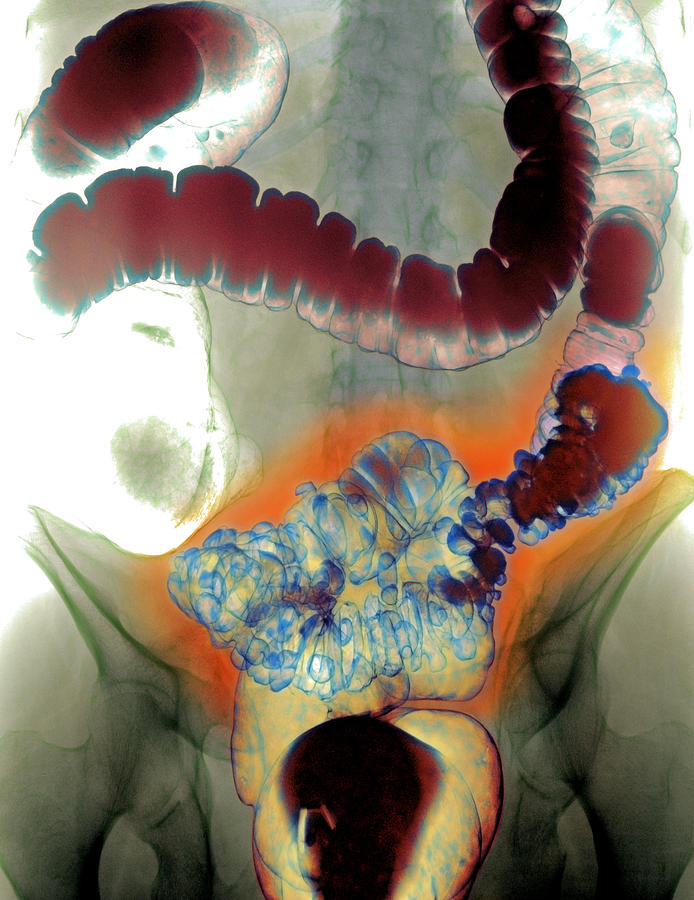 Colon Diverticula X Ray Photograph By Du Cane Medical Imaging Ltd