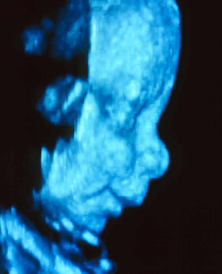 Pregnancy Photograph - Coloured 3-d Ultrasound Scan Of A Foetus Head by Bernard Benoit