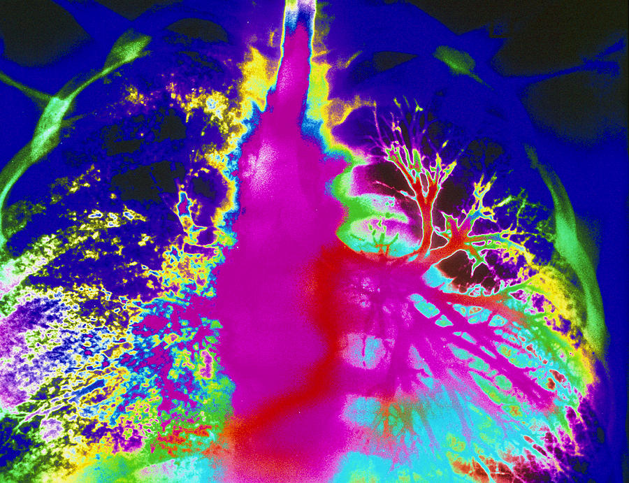 Bronchiectasis Photograph - Coloured Bronchogram Showing Bronchiectasis by Mehau Kulyk