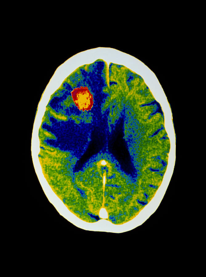 Coloured Ct Scan Of Brain Abscess In Aids Patient Photograph by - Fine ...