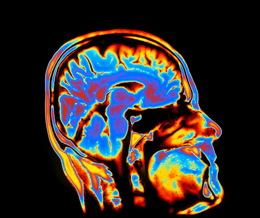 Coloured Ct Scan Of The Brain In Head (side View) Photograph by Pasieka ...