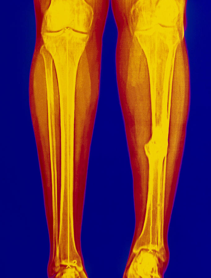 Coloured X-ray Of Fractured Shin Bone (tibia) Photograph ...