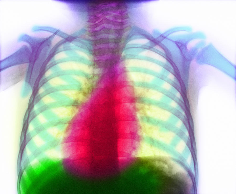 Coloured X-ray Of Heart Showing Dextrocardia Photograph by - Pixels