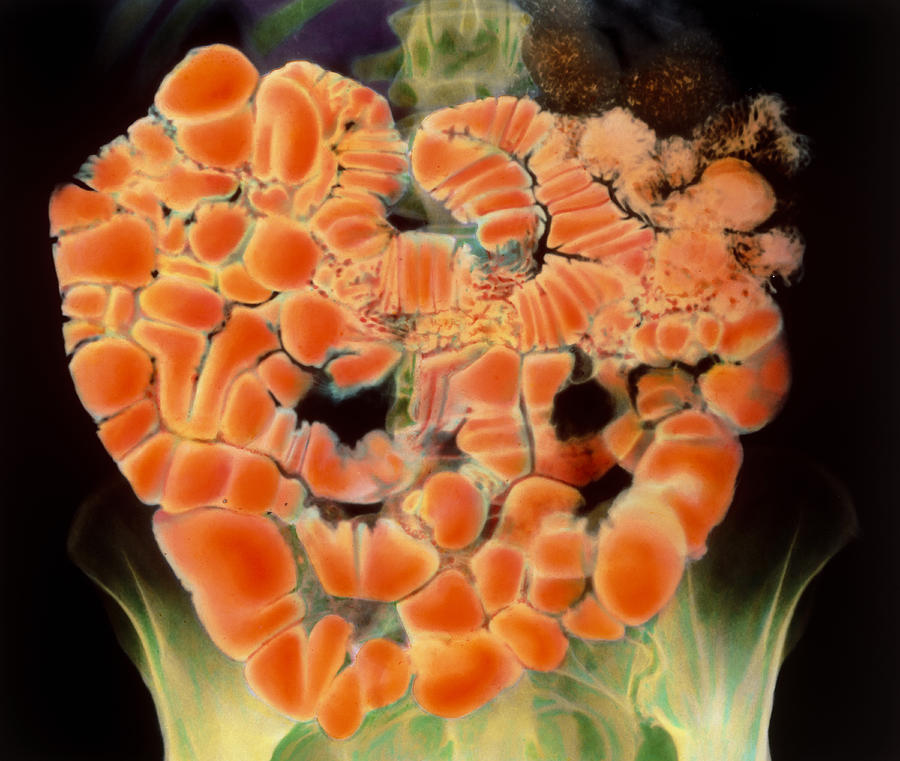 Small Intestine Photograph - Coloured X-ray Of The Human Small Intestine by 