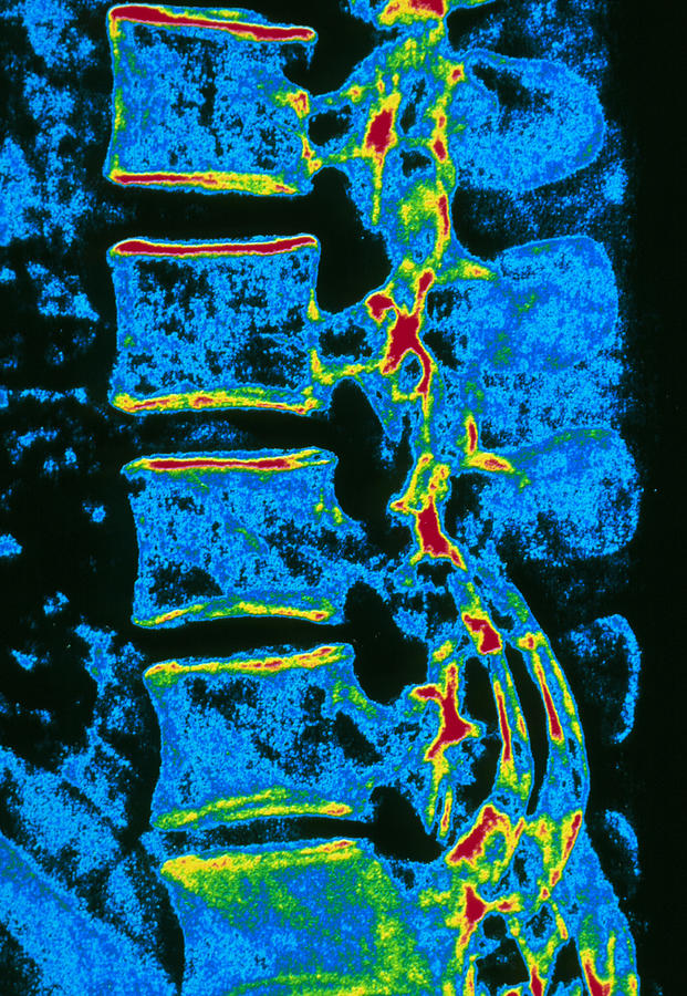 Coloured X-ray Of Vertebrae With Osteoporosis Photograph by Pasieka ...