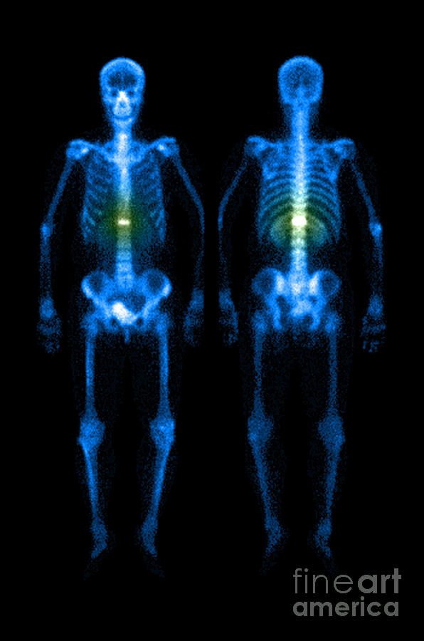 Compression Fracture Photograph by Medical Body Scans