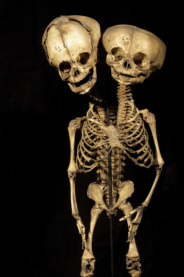 Skeleton Photograph - Conjoined Twins by Arno Massee