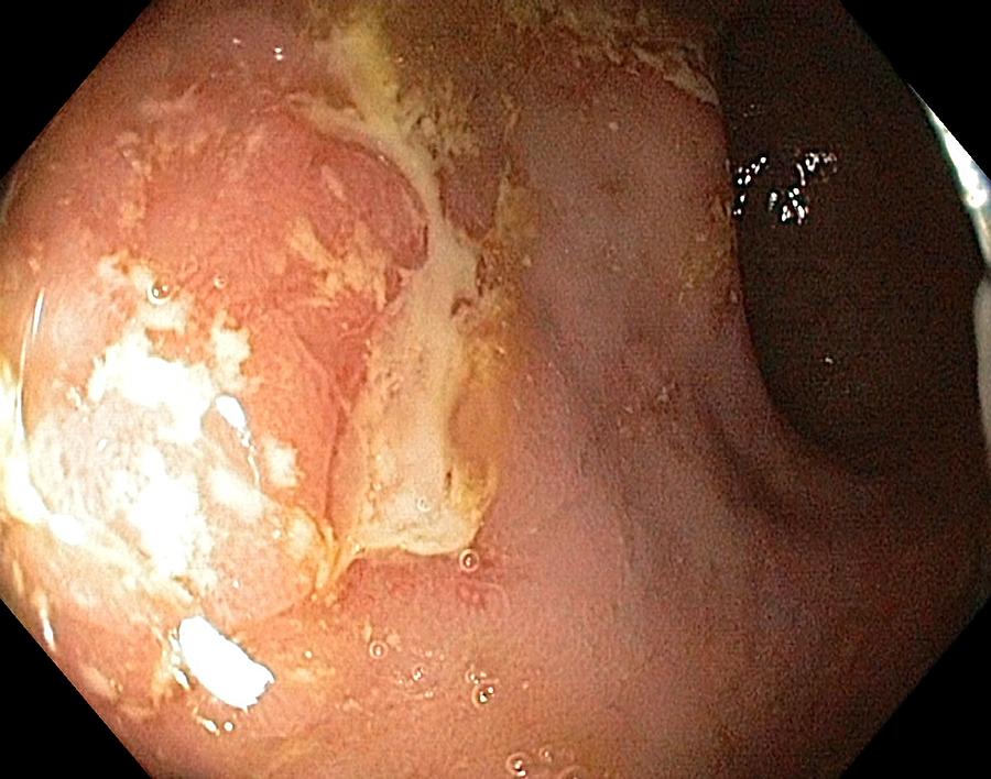 Endoscopy Photograph - Crohns Disease In The Rectum by Gastrolab