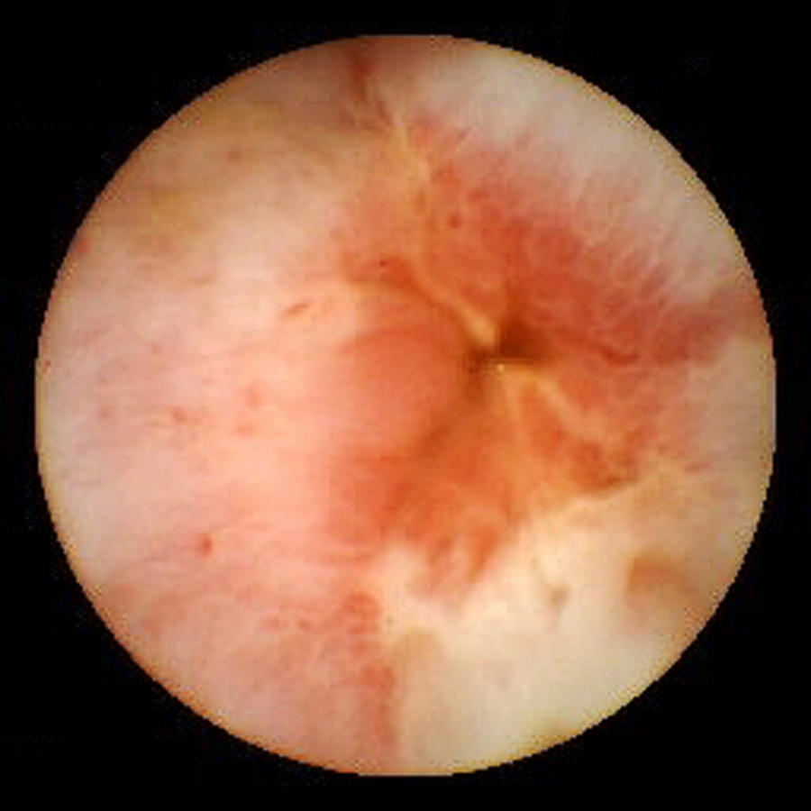 Crohn's Disease Photograph - Crohns Disease Inflammation, Pill Camera by David M. Martin, Md