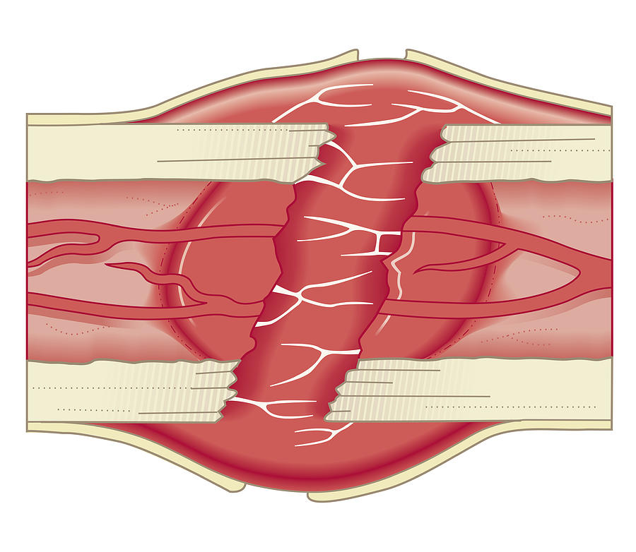 Cross Section Biomedical Illustration Of Bone Repairing Itself With Clot Forming To Seal Broken Blood Vessels And Fibrous Tissue Forming To Replace The Clot Digital Art by Dorling Kindersley