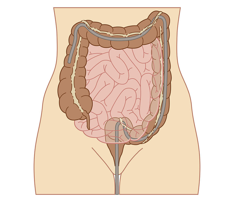 Cross Section Biomedical Illustration Of Colonoscopy Procedure In Adult Female Digital Art by Dorling Kindersley