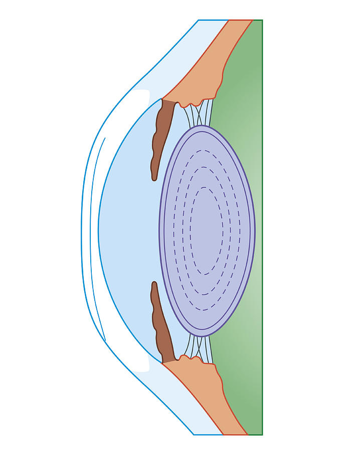 Cross Section Biomedical Illustration Of Human Eye After Corrective ...