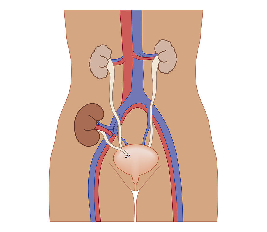 Cross Section Biomedical Illustration Of Kidney Transplant Digital Art by Dorling Kindersley