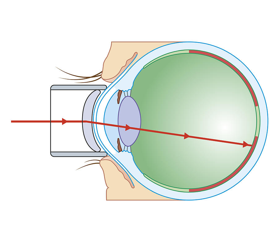 Глаз после лазерной коагуляции сетчатки. Лазерная коагуляция сетчатки глаза. Лазерной коагуляции сосудов сетчатки. Спайка сетчатки лазером. Периферическая лазеркоагуляция сетчатки глаза.