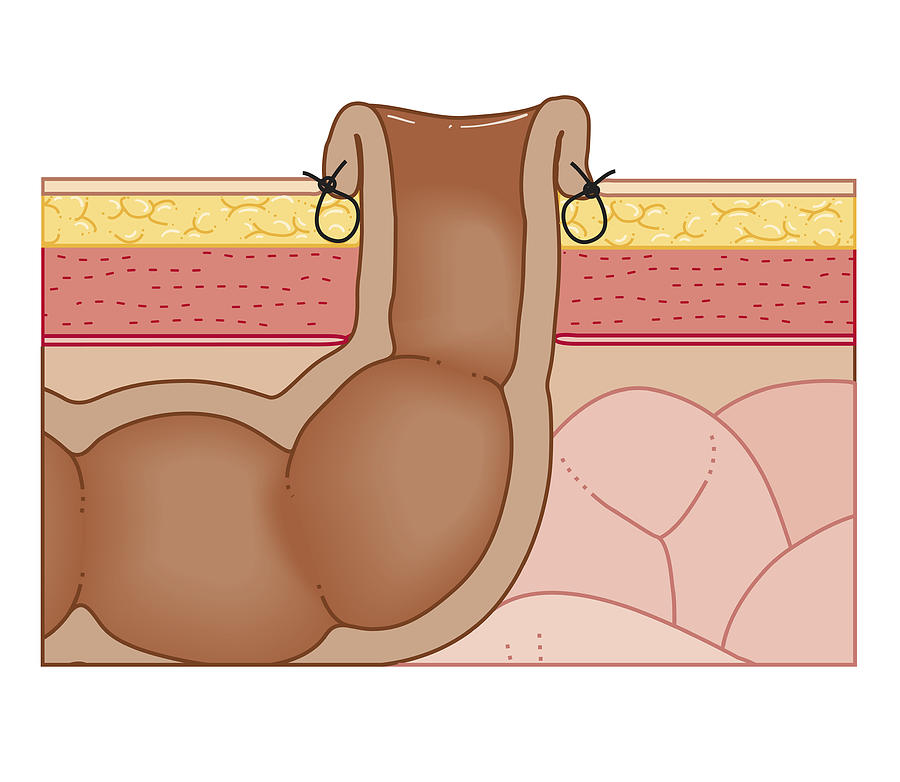 Cross Section Biomedical Illustration Of Permanent Colostomy With Colon Sutured To Abdominal Wall Digital Art by Dorling Kindersley