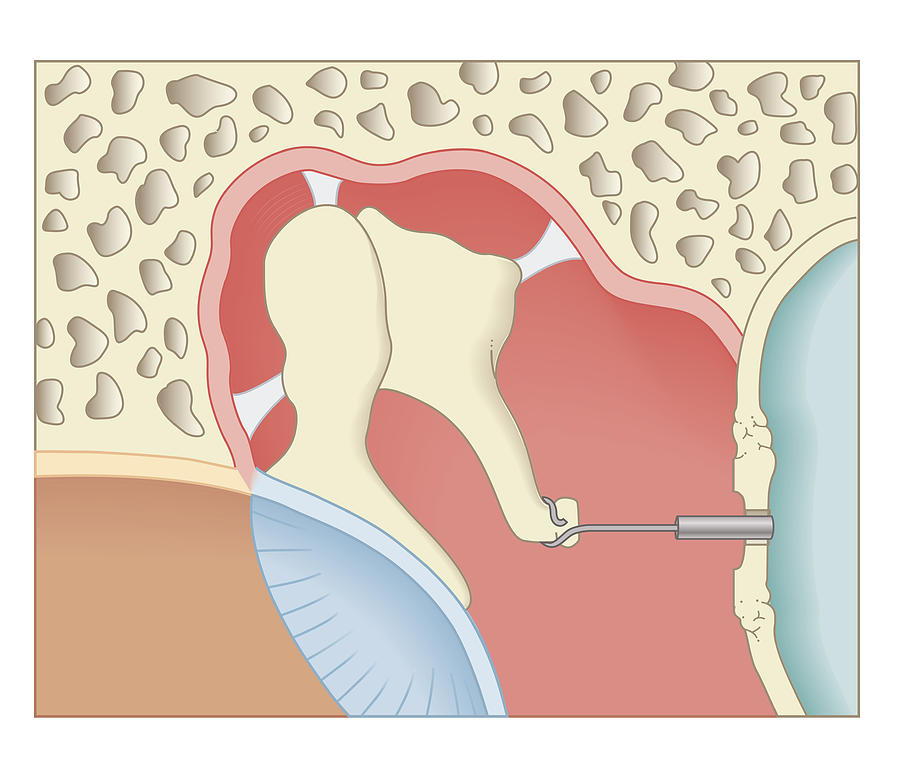 Cross Section Biomedical Illustration Of Post-operative Stapedotomy Surgery Digital Art by Dorling Kindersley
