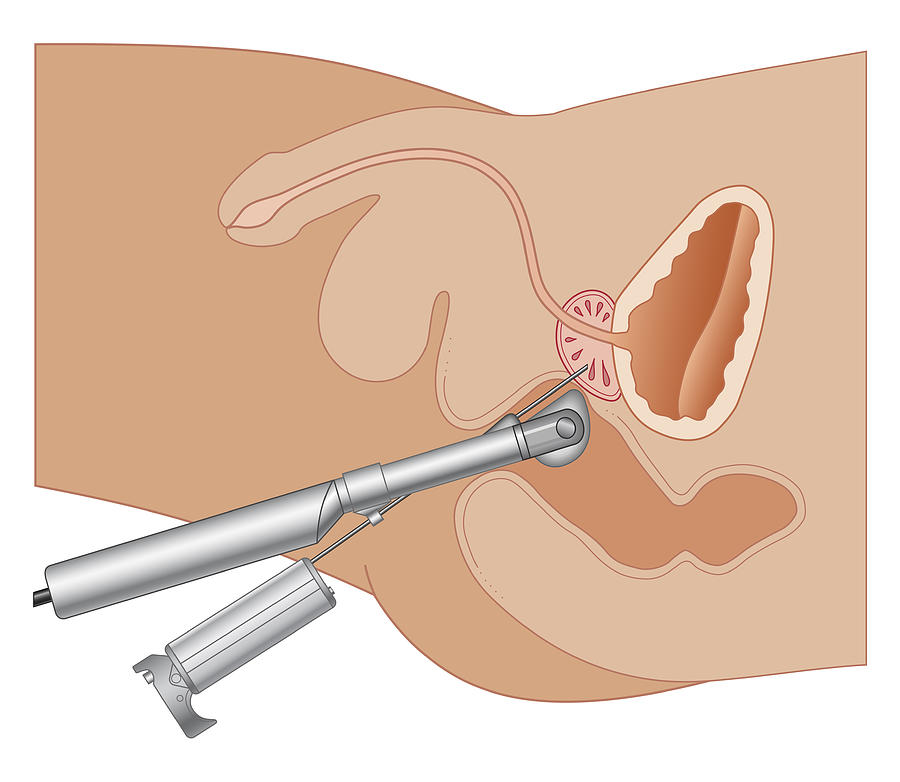 Cross Section Biomedical Illustration Of Prostate Gland Needle Biopsy Procedure Digital Art by Dorling Kindersley