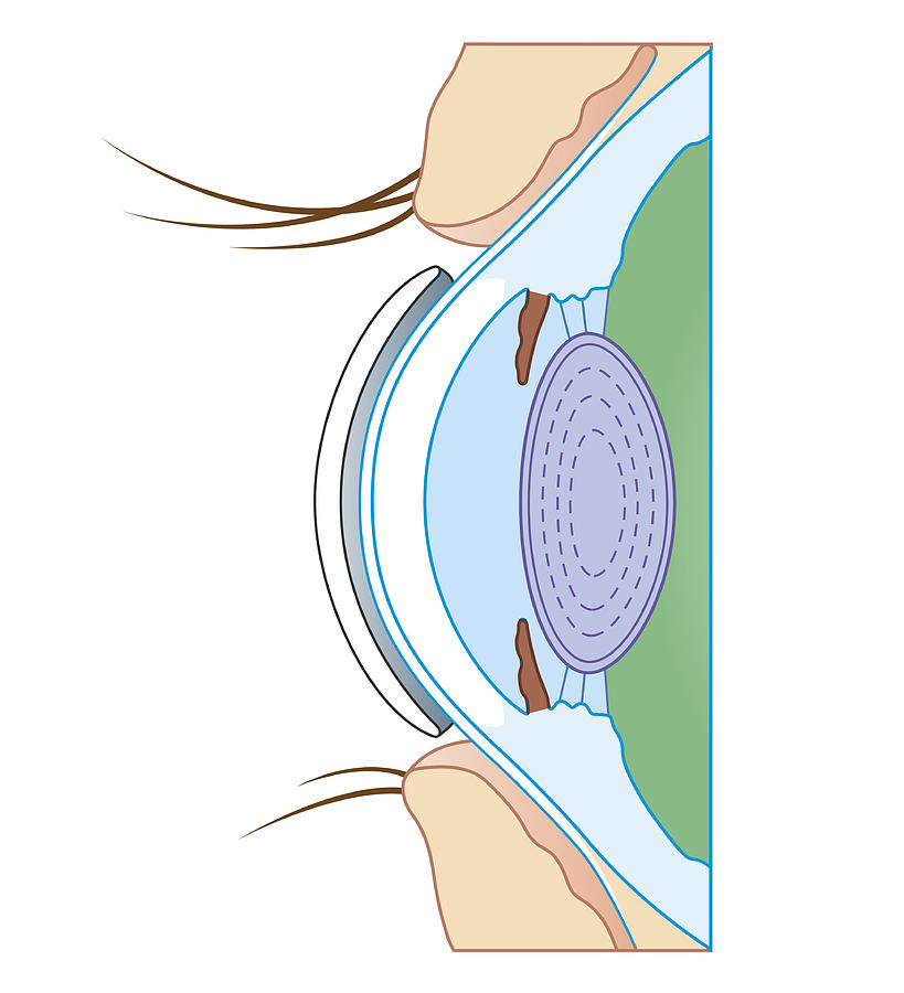 Cross Section Biomedical Illustration Of Soft Contact Lens On Eye Digital Art by Dorling Kindersley Cross Section Biomedical Illustration Of Soft Contact Lens On Eye Digital Art by Dorling Kindersley