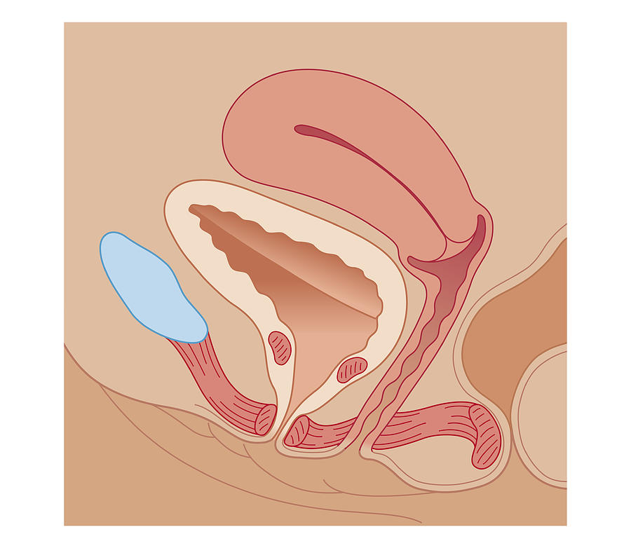 Cross Section Biomedical Illustration Of Urinary Incontinence In Female Digital Art by Dorling Kindersley