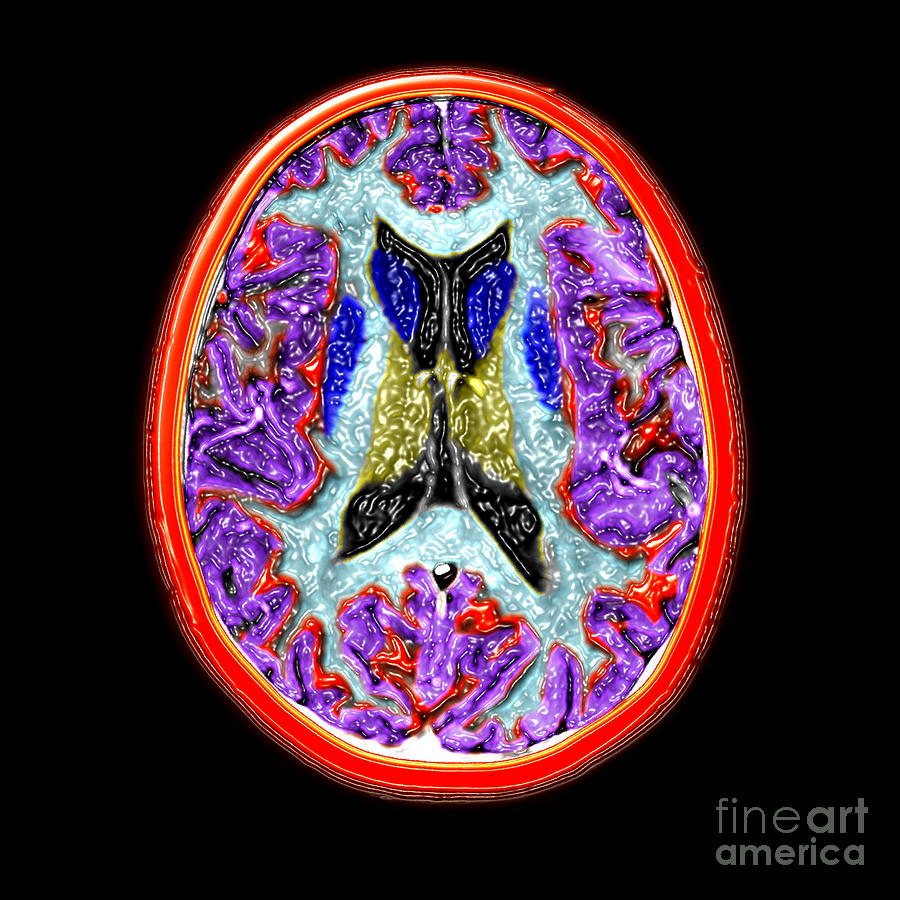 Cross-sectional Mri Of The Human Brain Photograph by Medical Body Scans