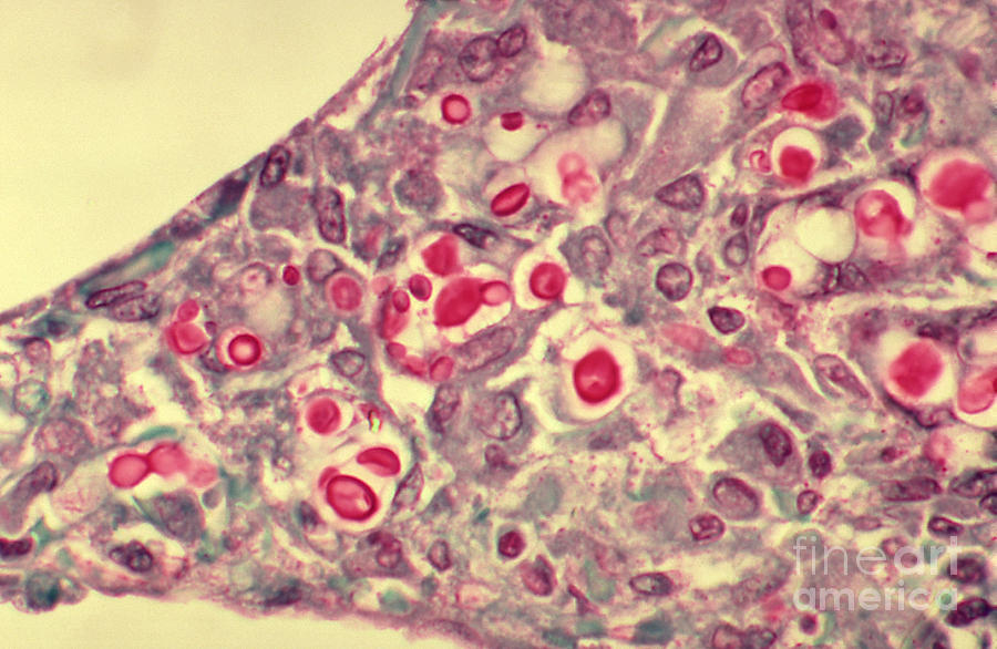 Cryptococcosis, Lm Photograph by Science Source
