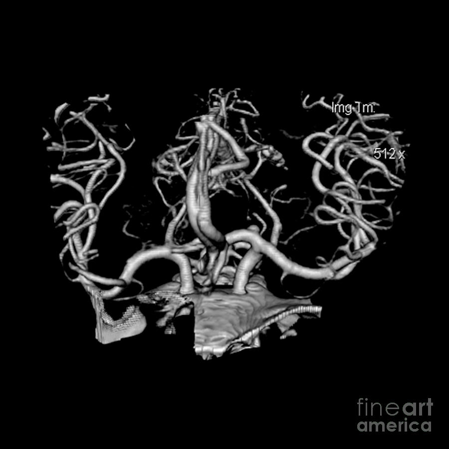 Ct Angiogram Of Aneurysm Photograph by Medical Body Scans