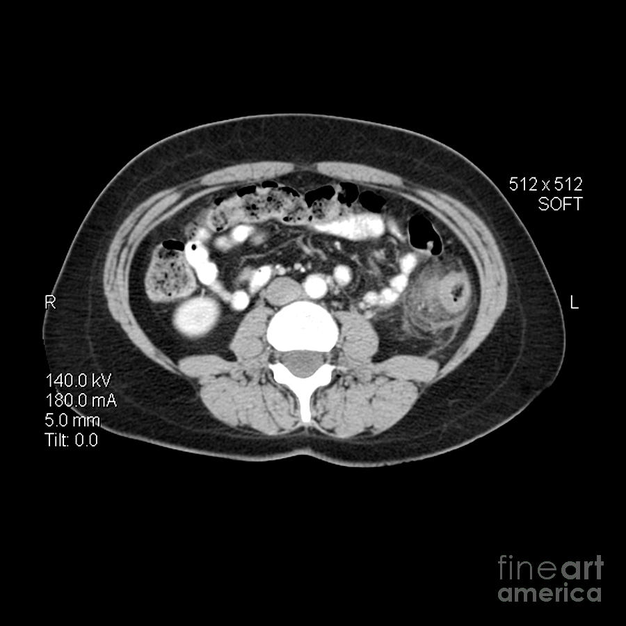 Ct Image Of Diverticulitis Photograph by Medical Body Scans