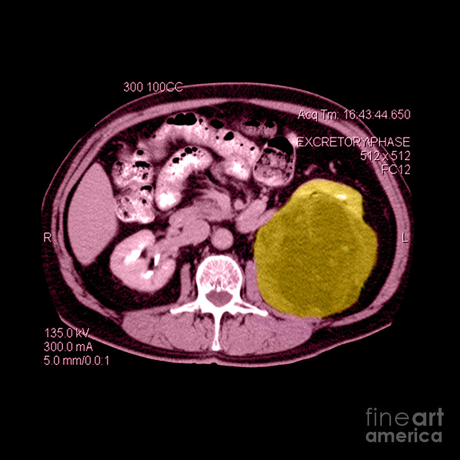 Ct Of Abdomen, Large Renal Carcinoma Photograph by Medical Body Scans