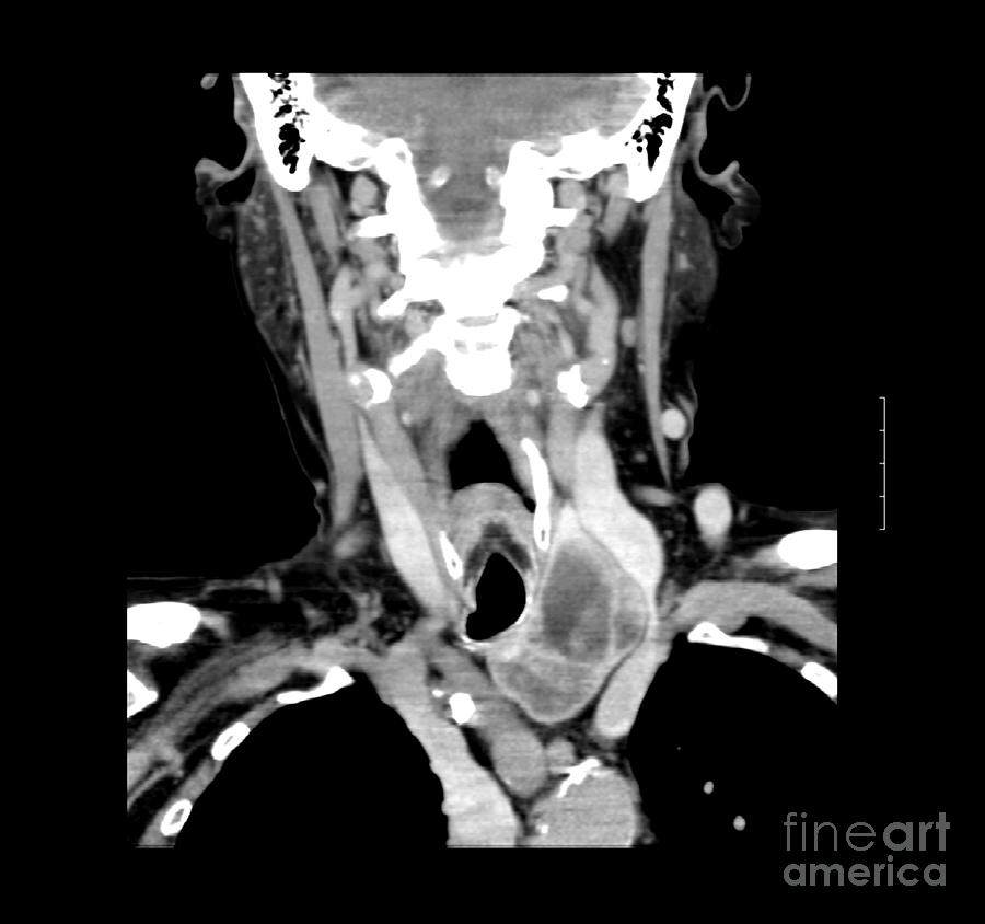 Ct Of Neck Showing Thyroid Goiter Photograph by Medical Body Scans - Pixels