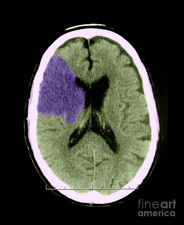Ct Of Stroke Photograph by Medical Body Scans