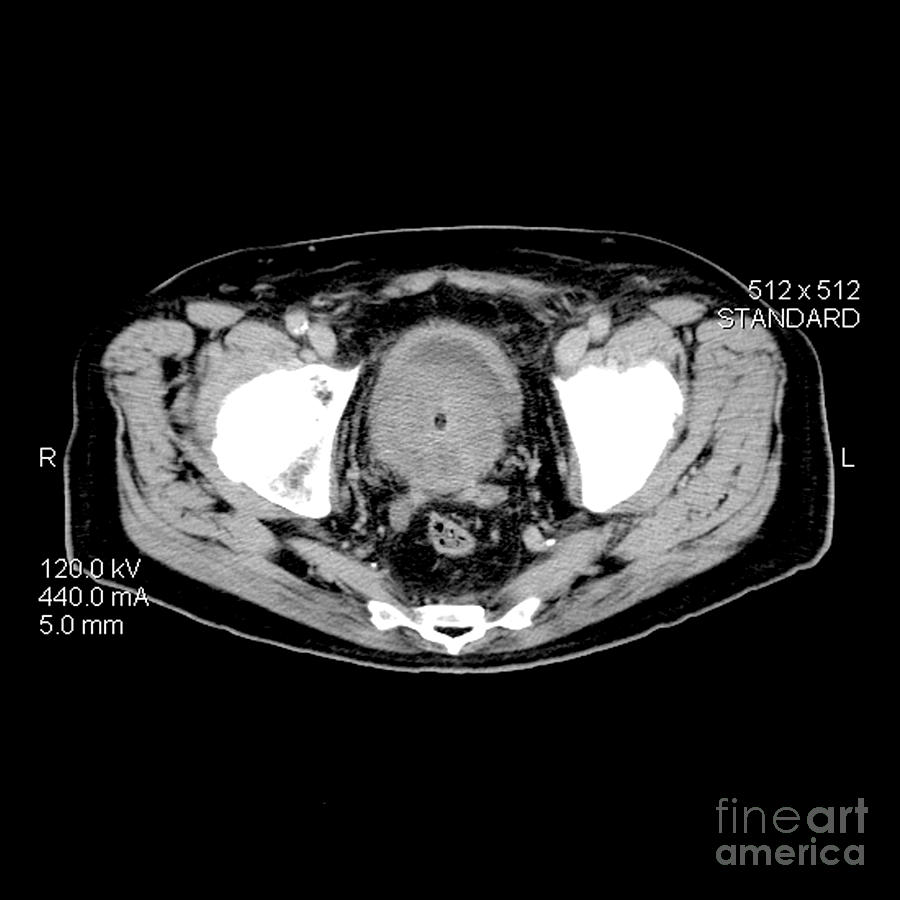 What Does A Ct Scan Show For Prostate Cancer