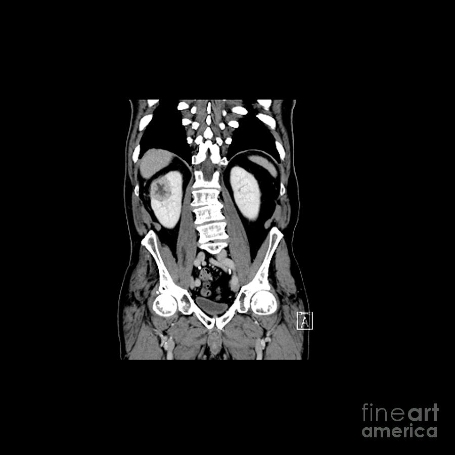 Ct Reconstruction Of Renal Cancer Photograph by Medical Body Scans