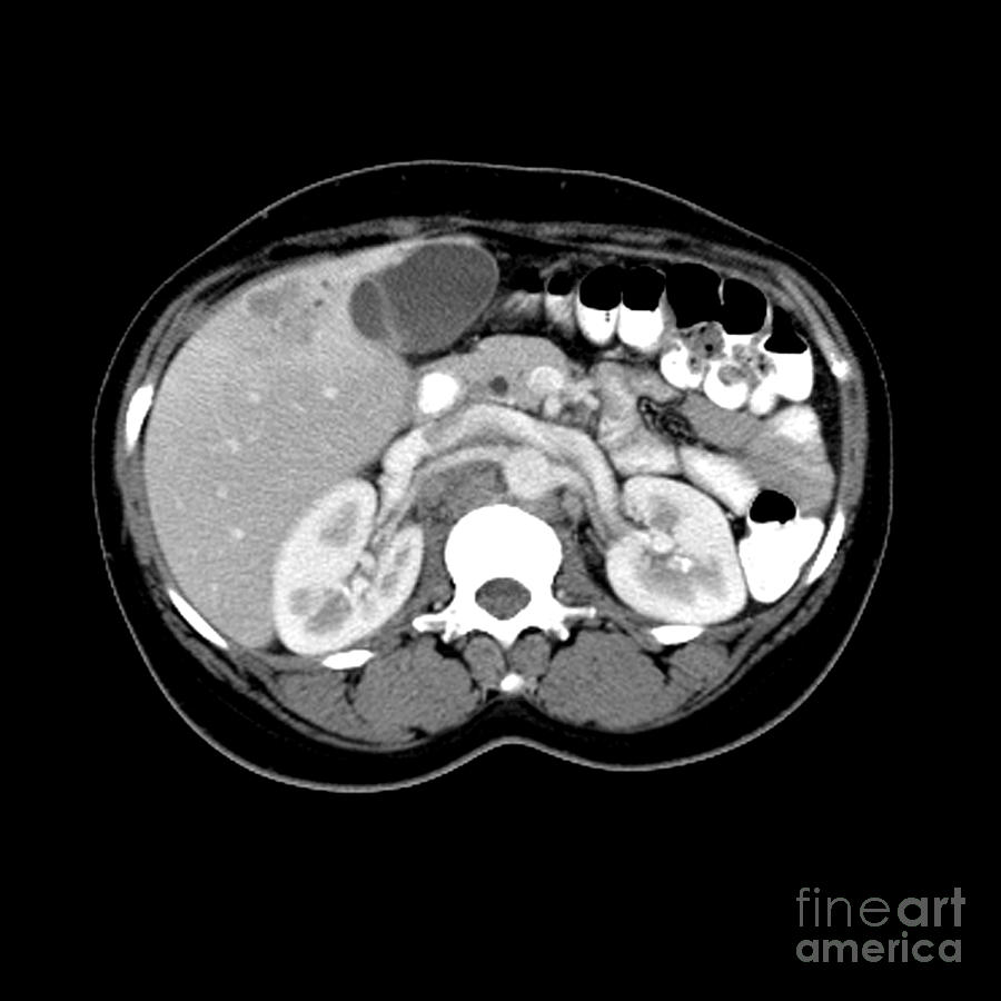 Ct Scan Of A Liver Tumor Photograph by Medical Body Scans