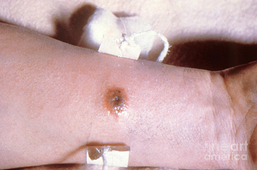 Cutaneous Anthrax Photograph by Science Source Pixels