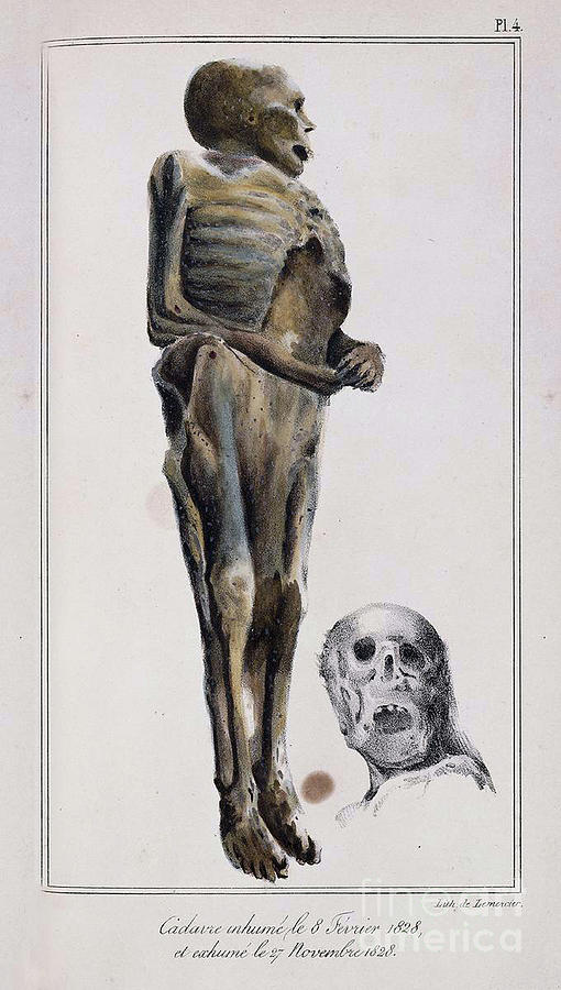 Decomposition On Exhumed Bodies, 1831 Photograph by Science Source