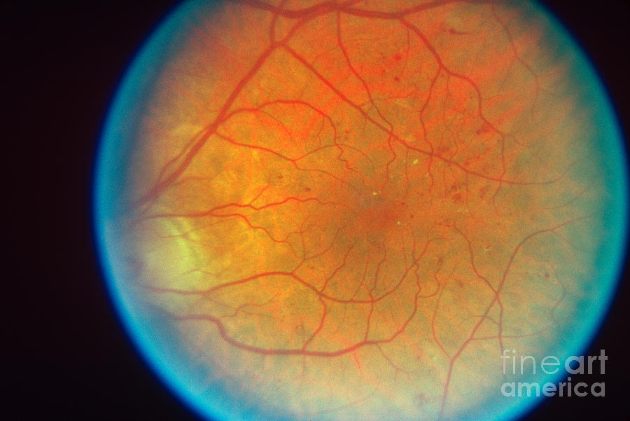 Diabetes And Cataracts Photograph by Science Source
