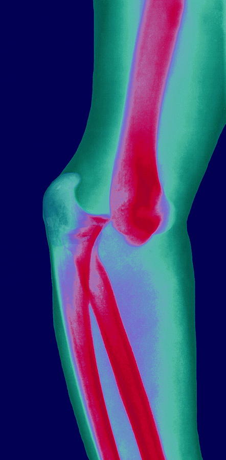 Elbow Photograph - Dislocated Elbow Joint, X-ray by Dr Linda Stannard, Uct