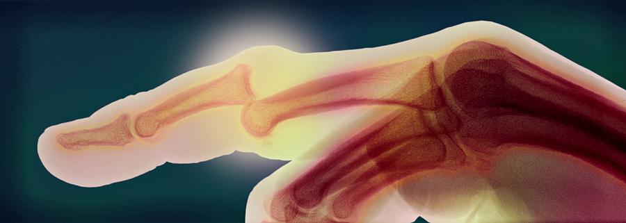 Skeleton Photograph - Dislocated Finger by Du Cane Medical Imaging Ltd