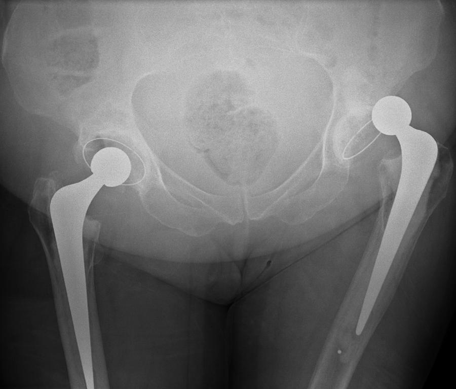 How To Know If Hip Replacement Is Dislocated