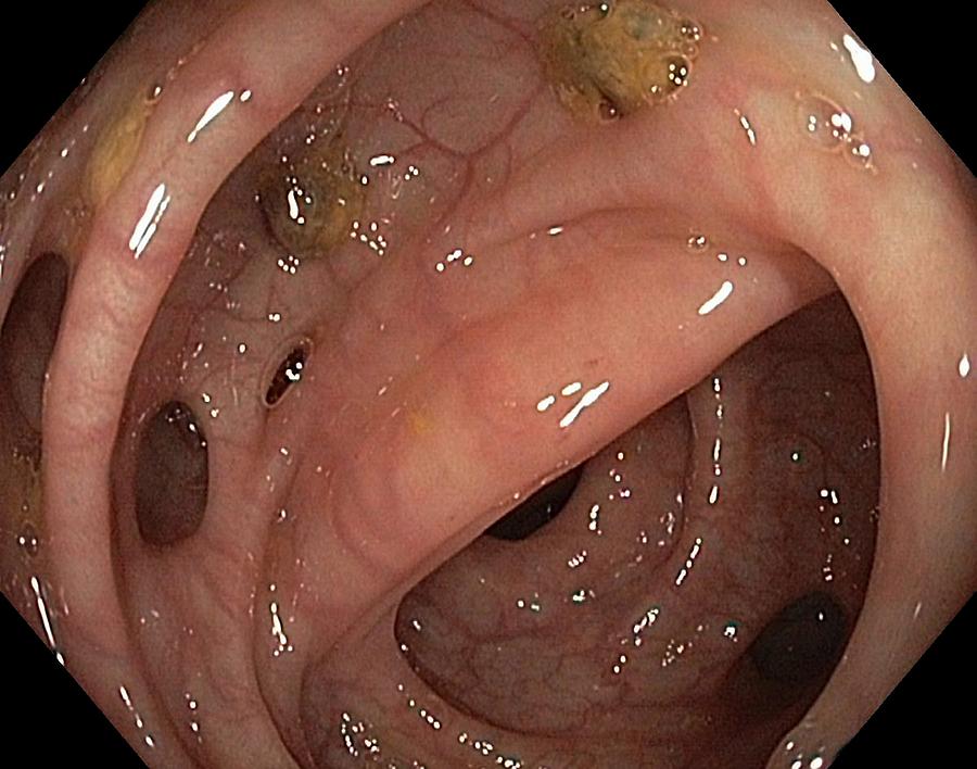 Endoscopy Photograph - Diverticular Disease In Sigmoid Colon by Gastrolab