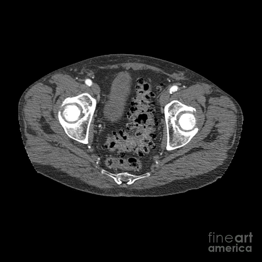 Diverticulosis Photograph by Medical Body Scans