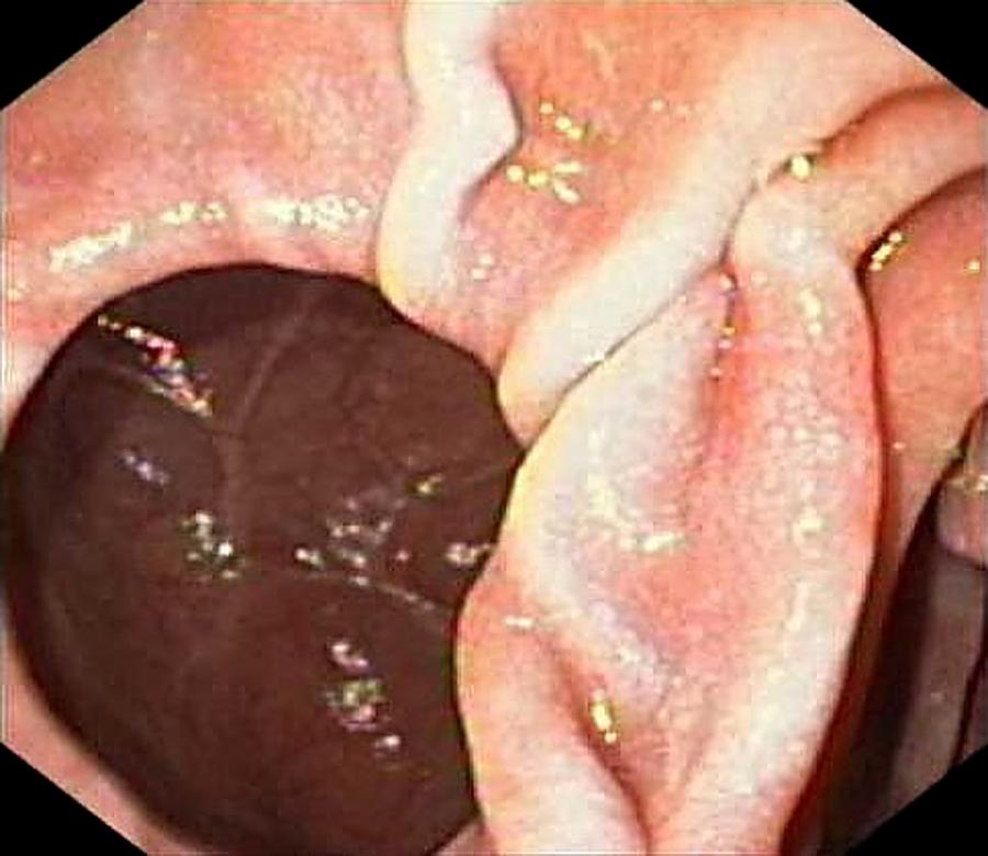 Endoscopy Photograph - Diverticulum In The Duodenum by Gastrolab